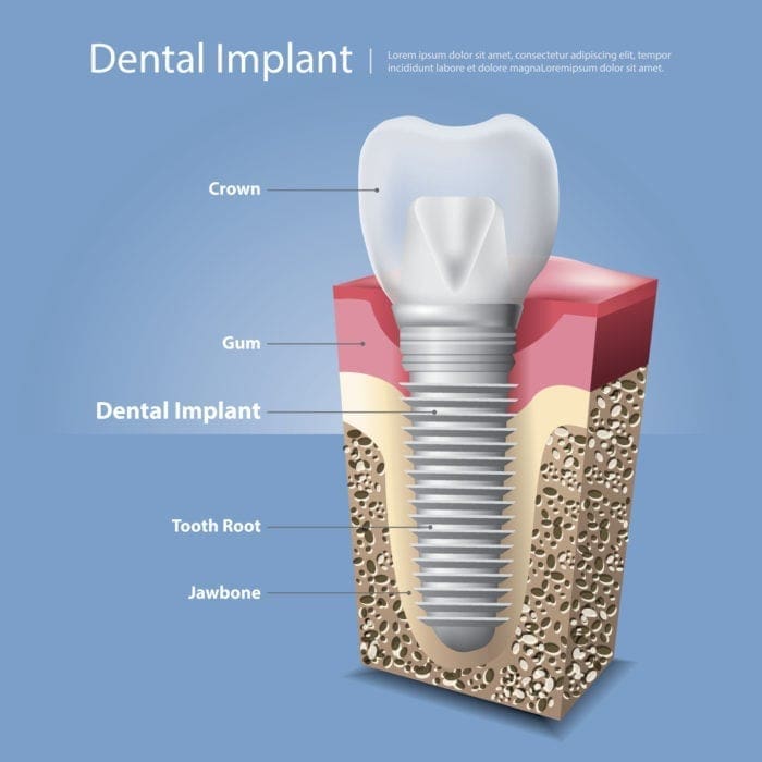 Illustration depicting a dental implant procedure.