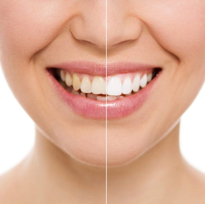 Illustration showing a person's smile before and after teeth whitening.
