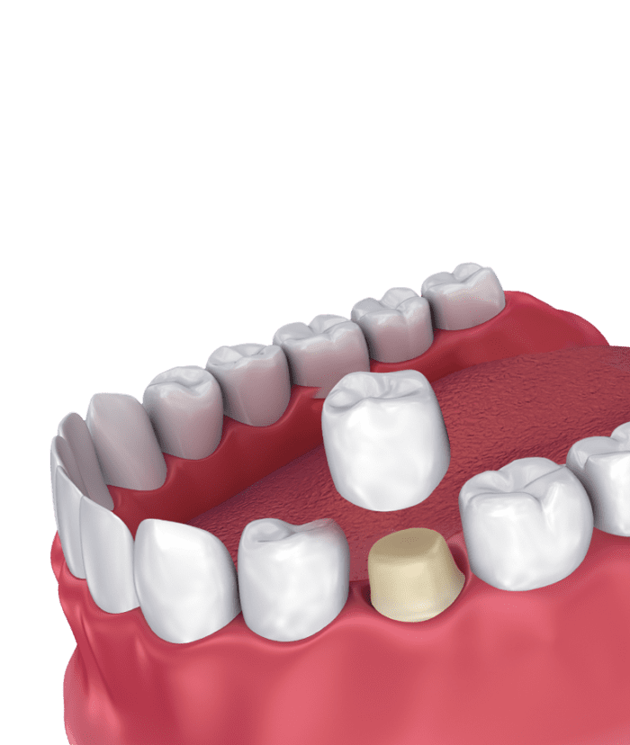 Illustration of professional dental restoration with dental crowns.