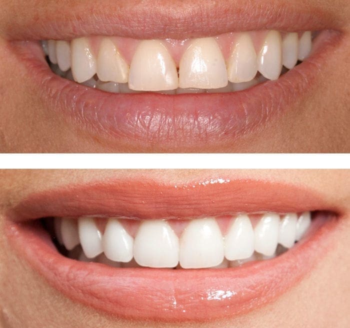 Two images comparing teeth before and after dental bonding.
