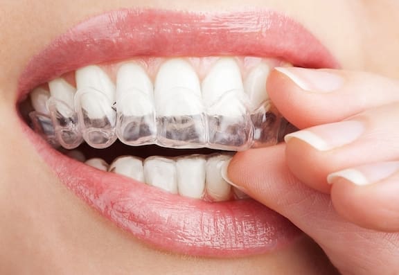 Girl wearing invisible braces.