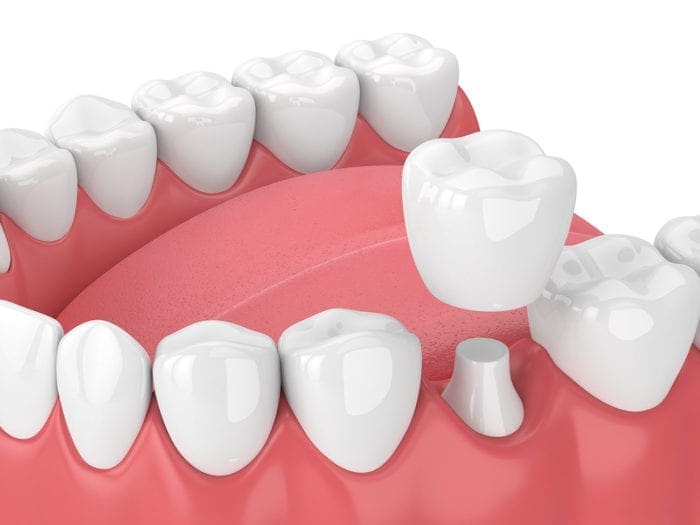 Illustration depicting a dental crown.
