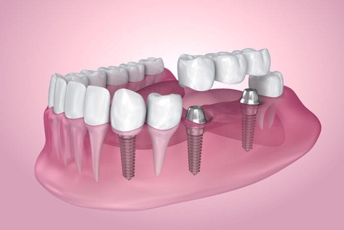 Image of a dental implant.