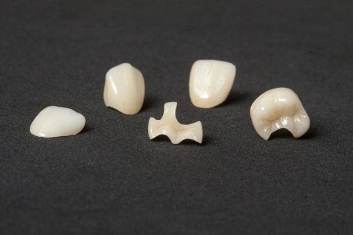 Illustration depicting dental inlays and onlays.