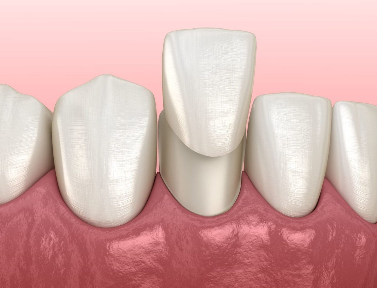 Image of porcelain veneers.
