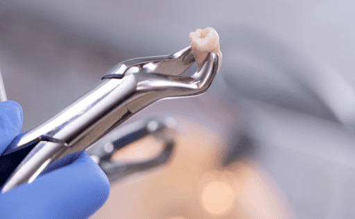 Image of a real tooth being held with an instrument.