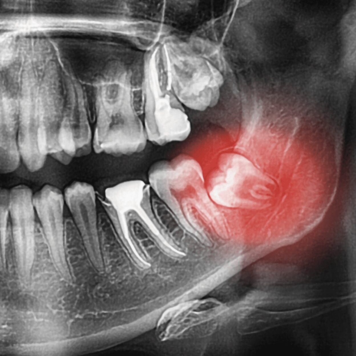 X-ray showing a toothache at Sudbury Dental Arts.